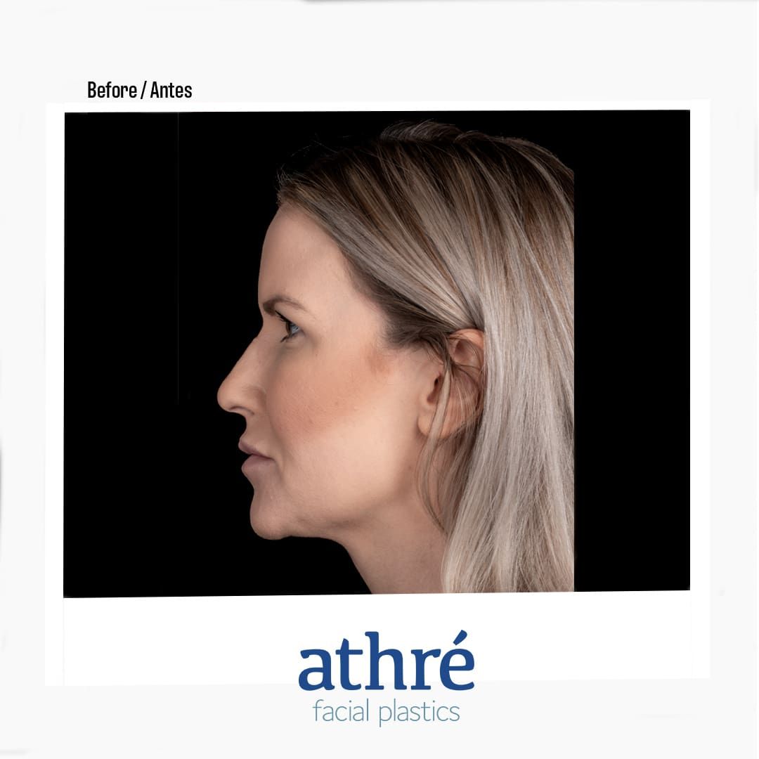 Revision Rhinoplasty Before & After