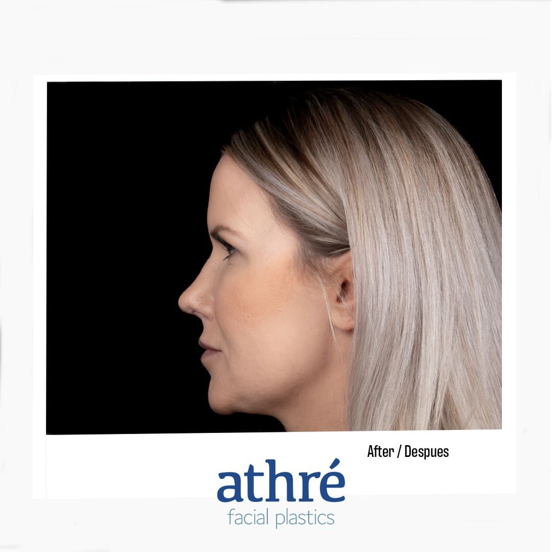 Revision Rhinoplasty Before & After