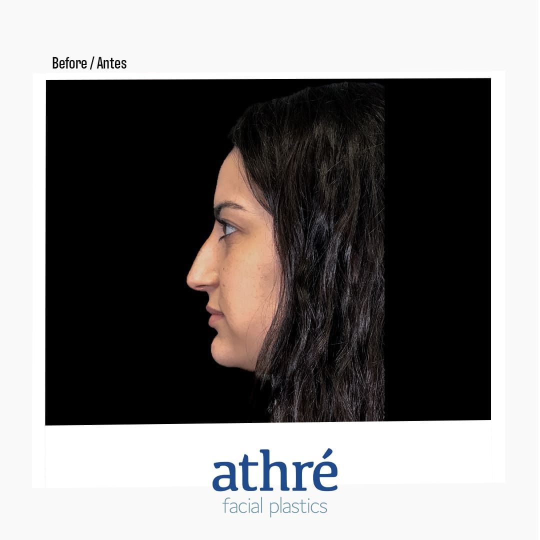 Revision Rhinoplasty Before & After