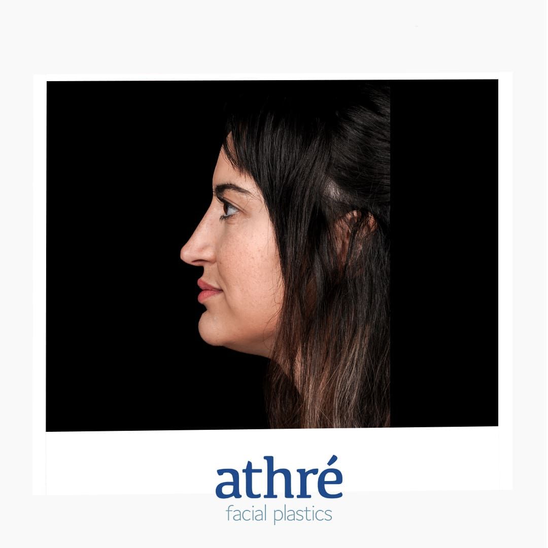 Revision Rhinoplasty Before & After