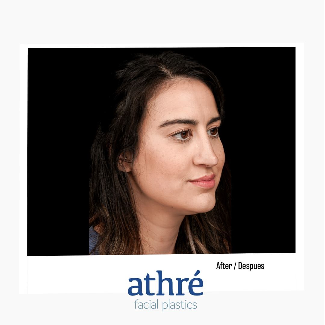 Revision Rhinoplasty Before & After