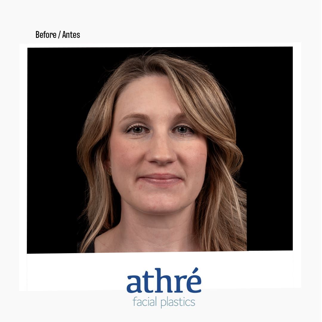 Revision Rhinoplasty Before & After