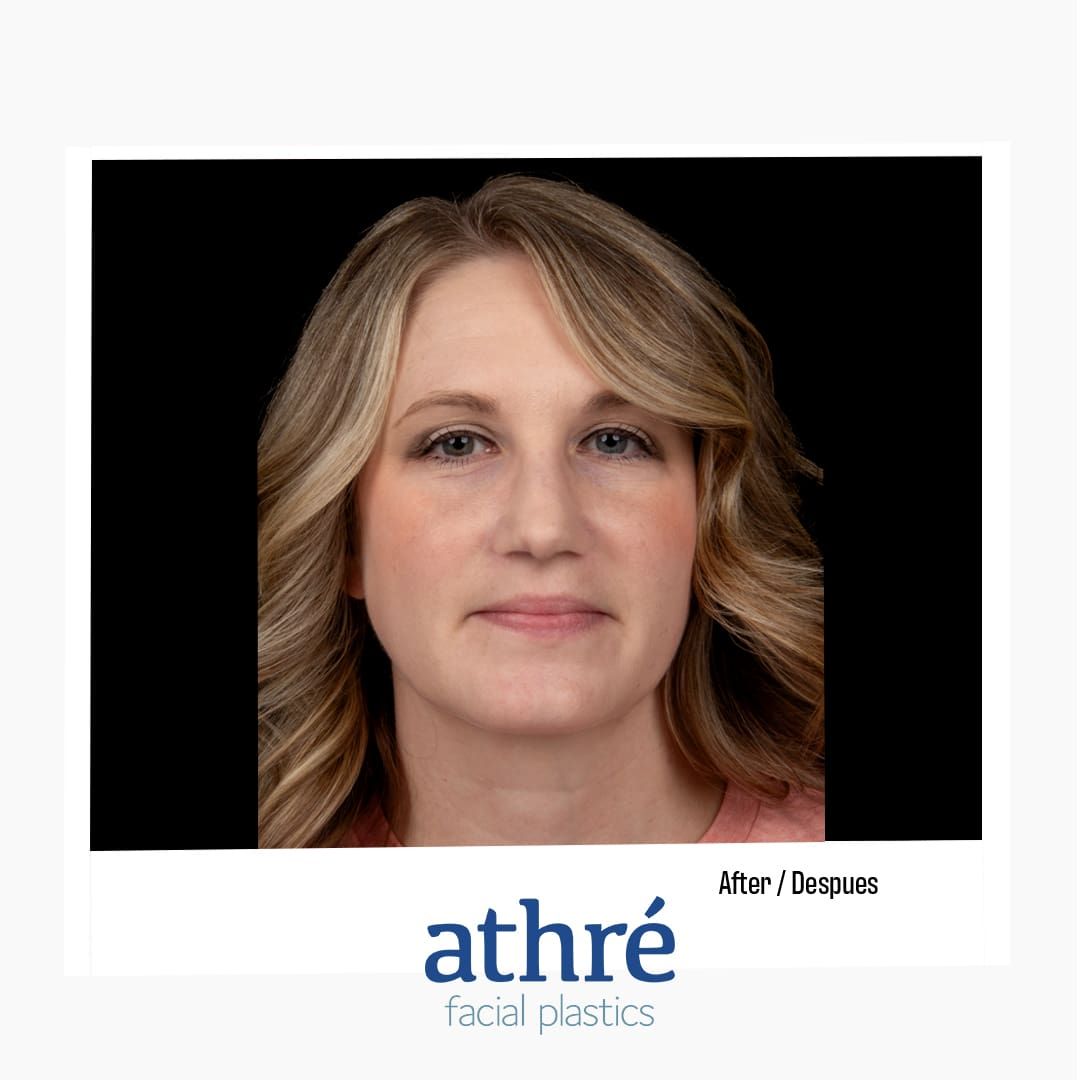 Revision Rhinoplasty Before & After