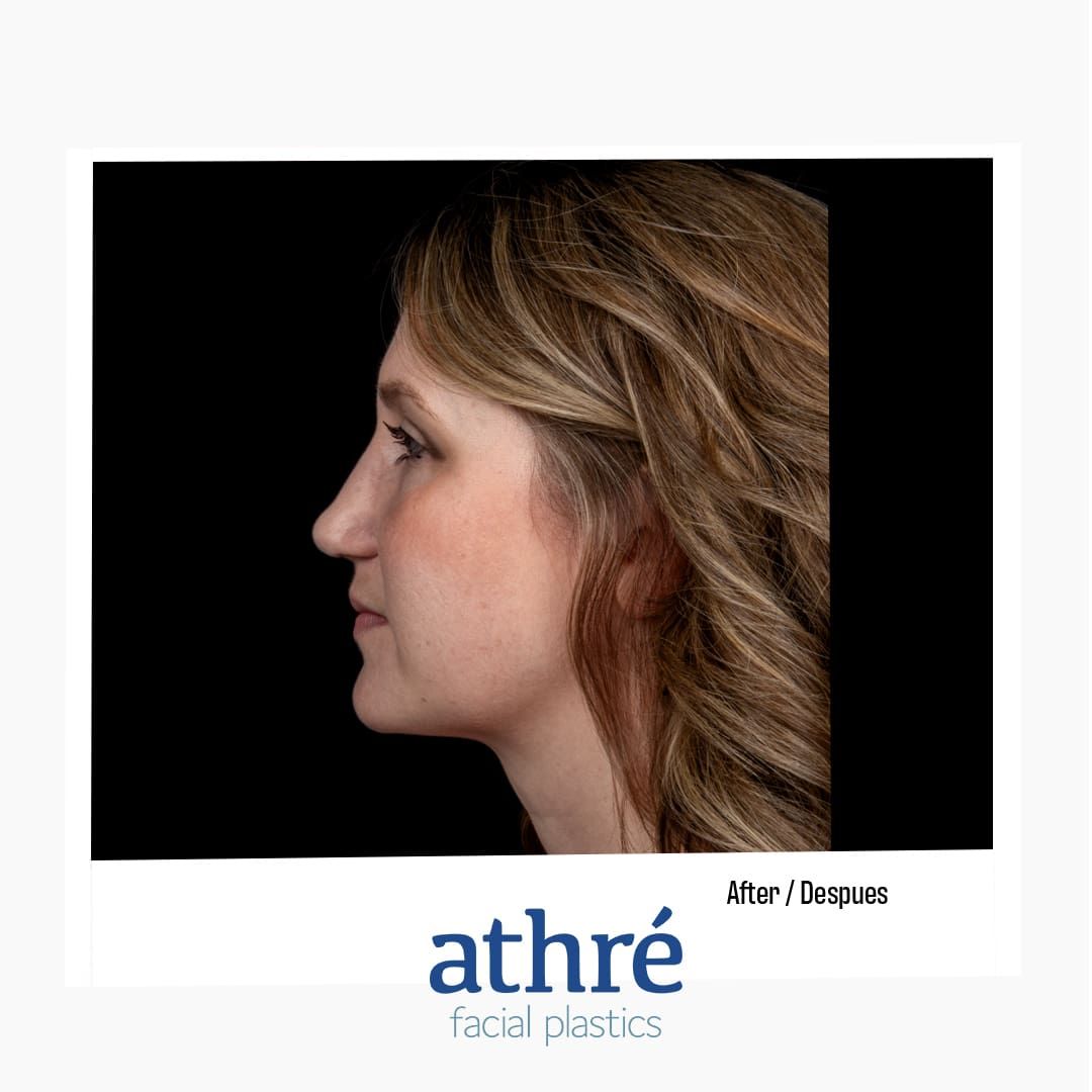 Revision Rhinoplasty Before & After