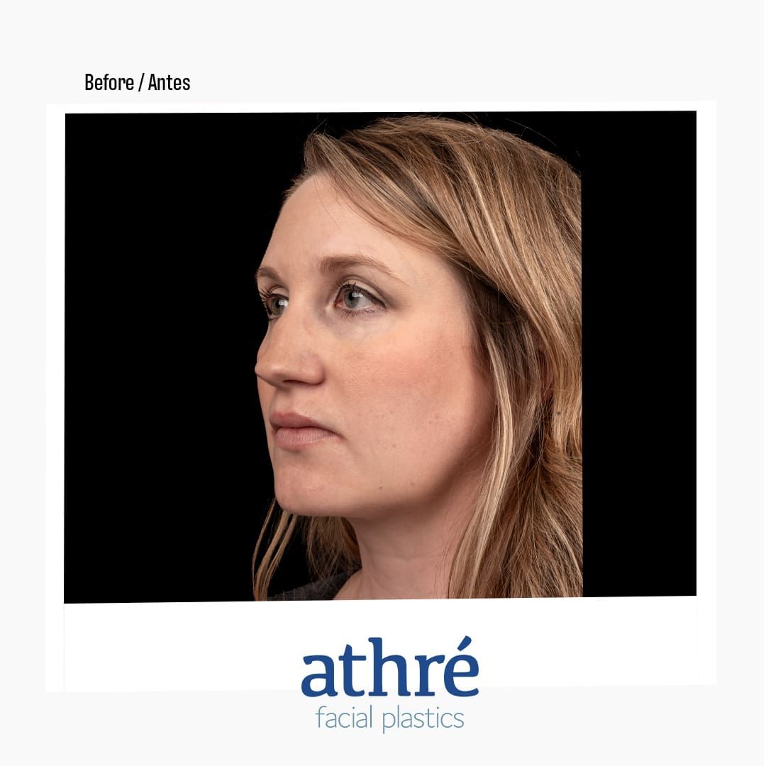 Revision Rhinoplasty Before & After