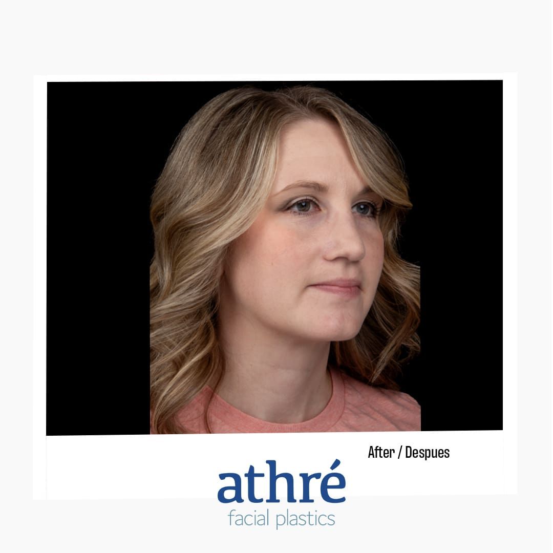 Revision Rhinoplasty Before & After