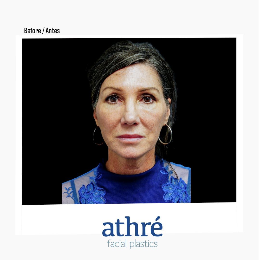 Revision Rhinoplasty Before & After