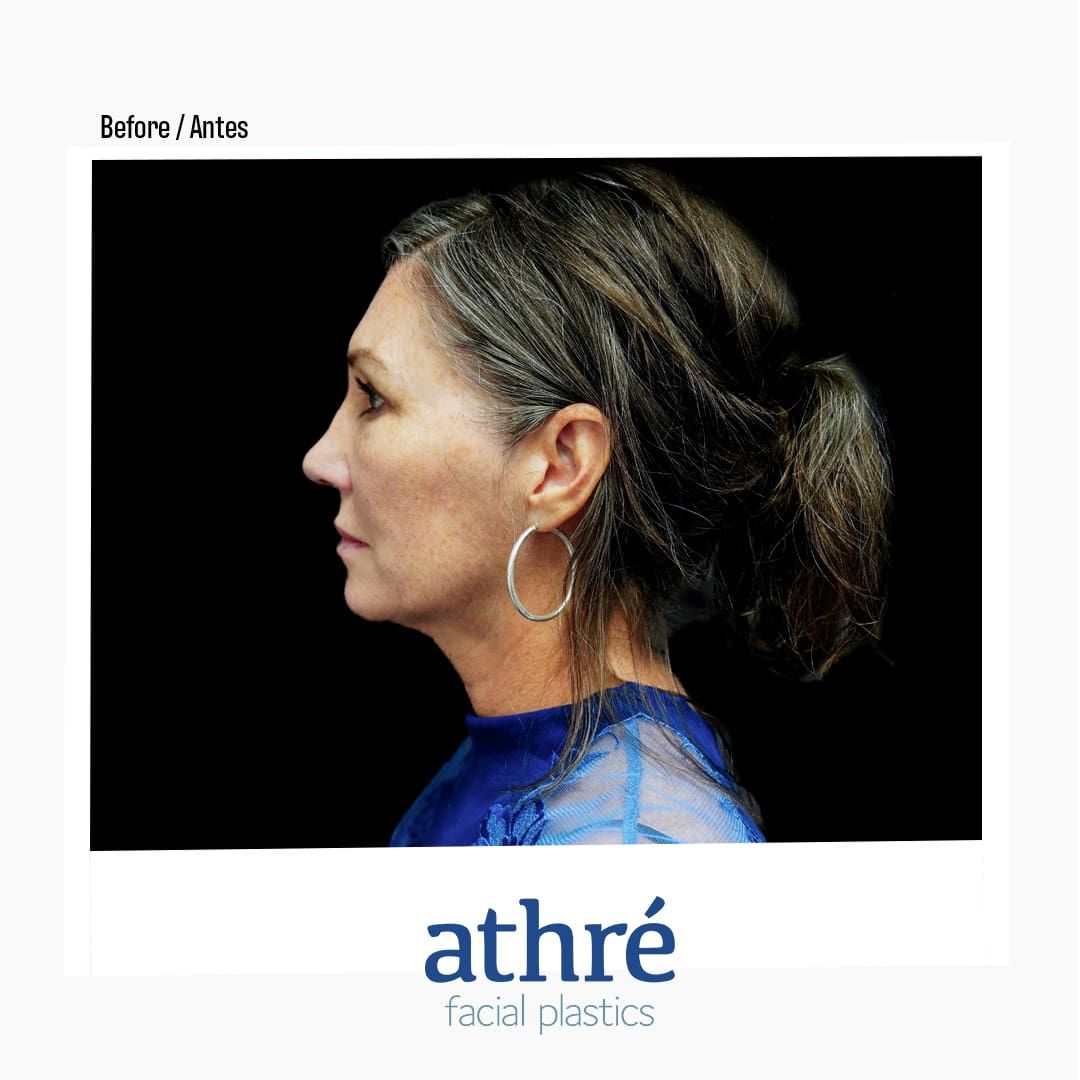 Revision Rhinoplasty Before & After