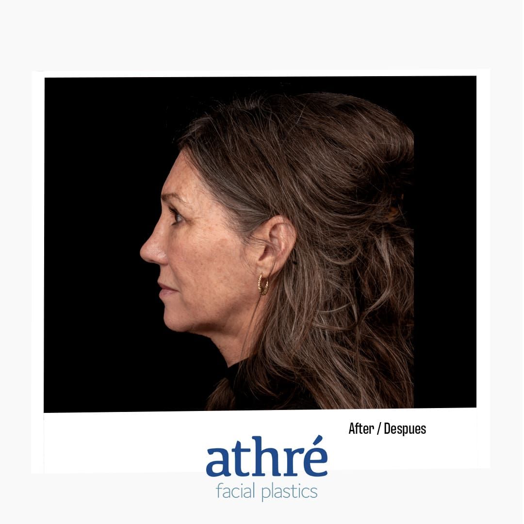 Revision Rhinoplasty Before & After