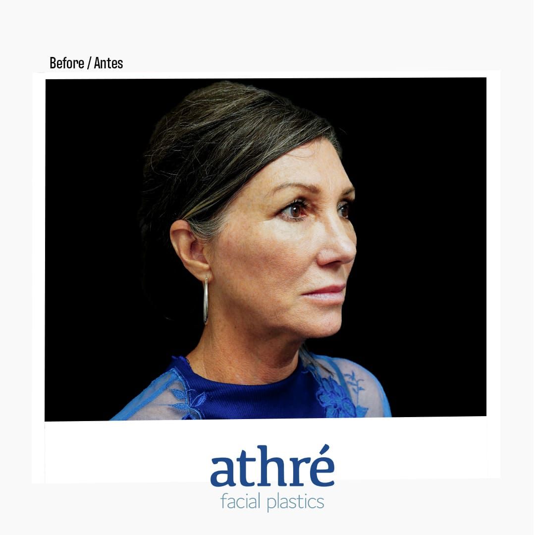 Revision Rhinoplasty Before & After