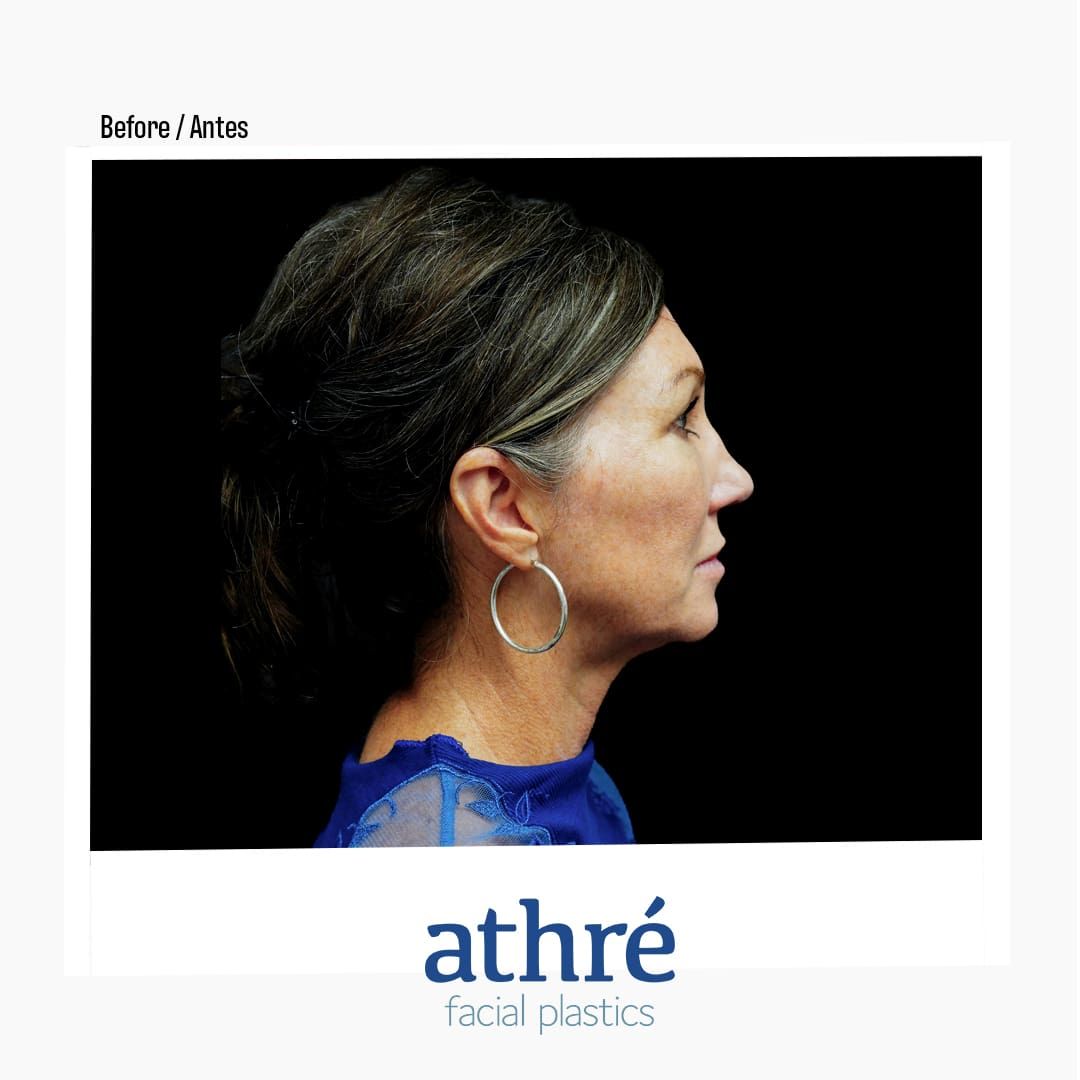 Revision Rhinoplasty Before & After