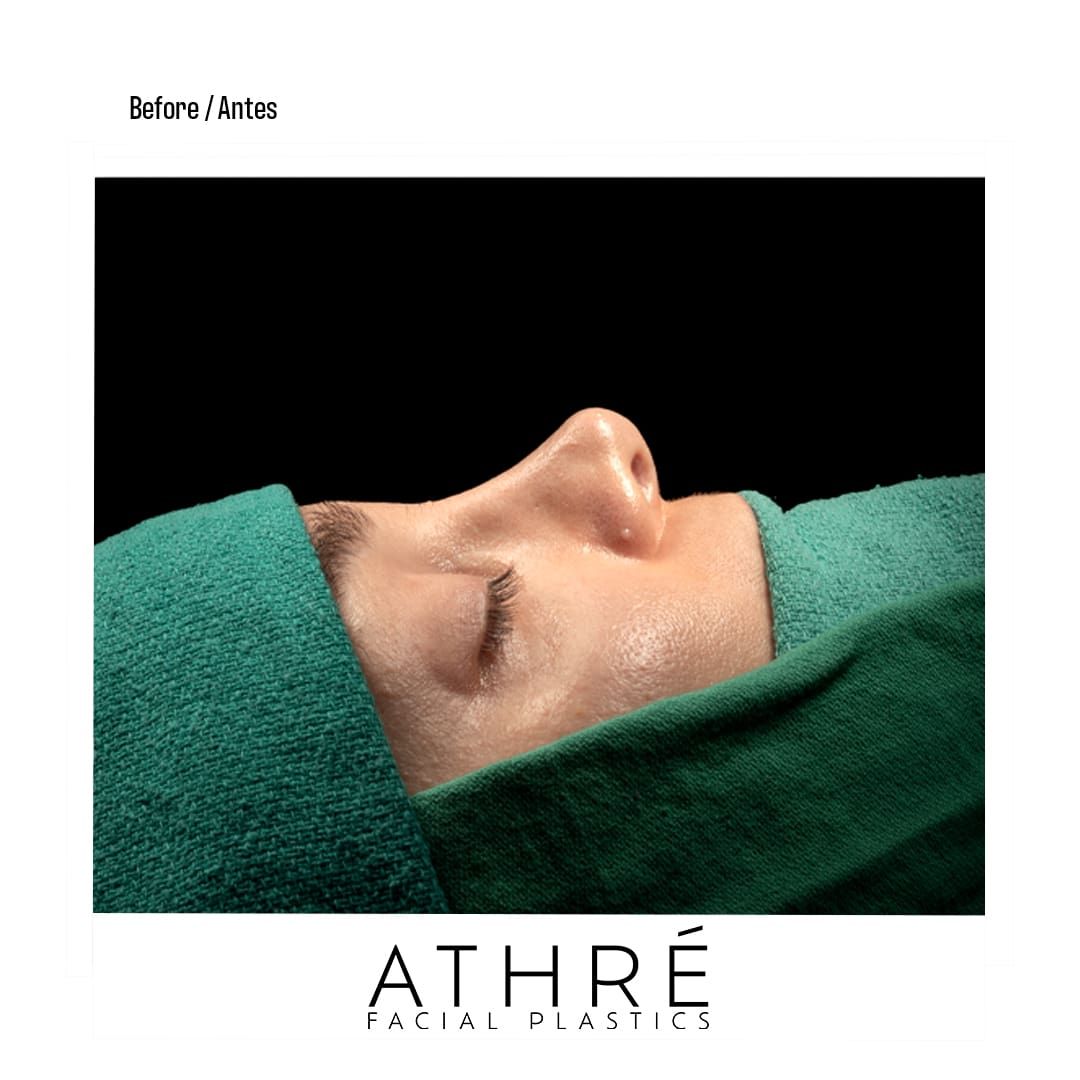 Revision Rhinoplasty Before & After