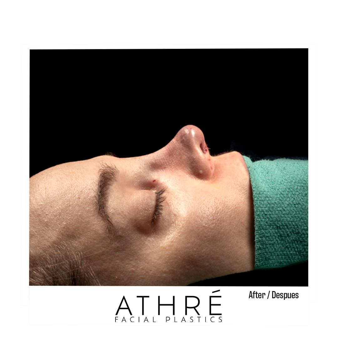 Revision Rhinoplasty Before & After