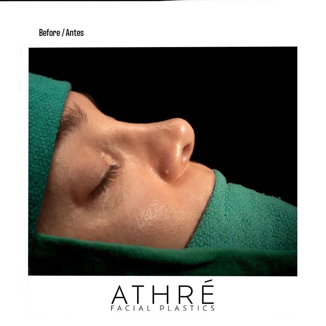 Revision Rhinoplasty Before & After