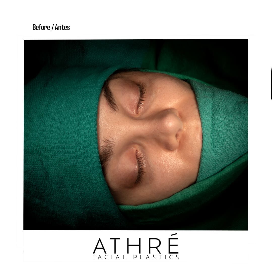 Revision Rhinoplasty Before & After