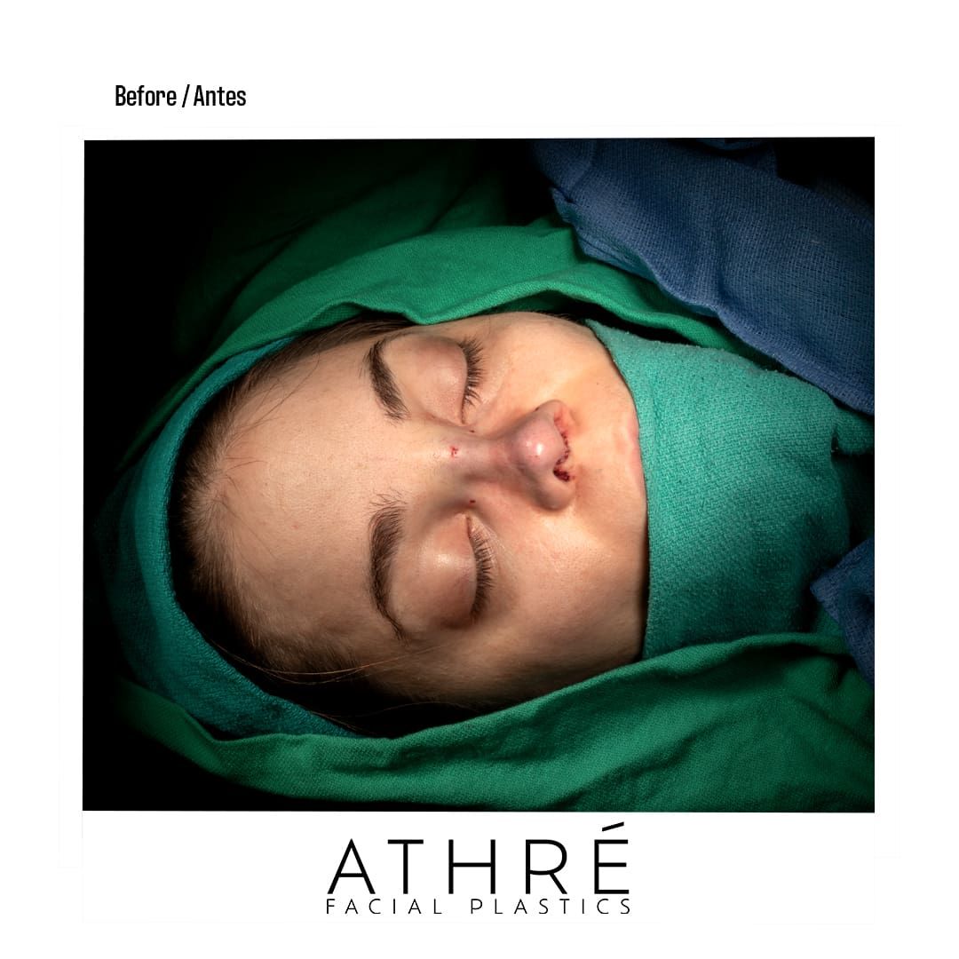 Revision Rhinoplasty Before & After