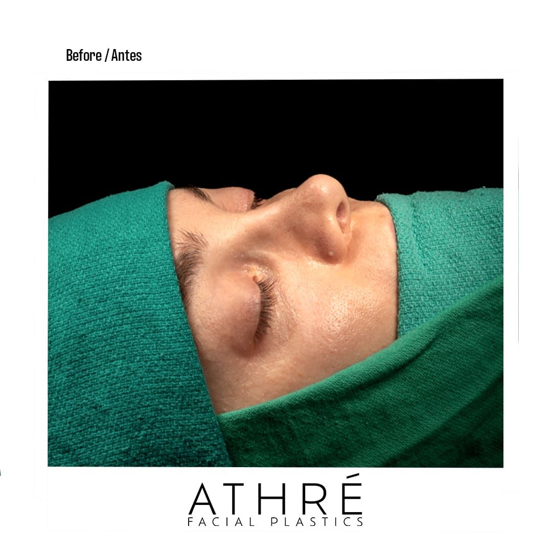 Revision Rhinoplasty Before & After