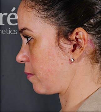 Facial Fat Transfer Before & After