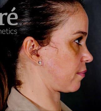 Facial Fat Transfer Before & After