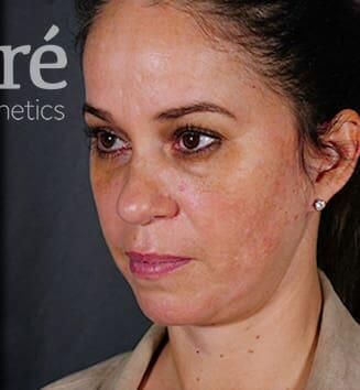 Facial Fat Transfer Before & After