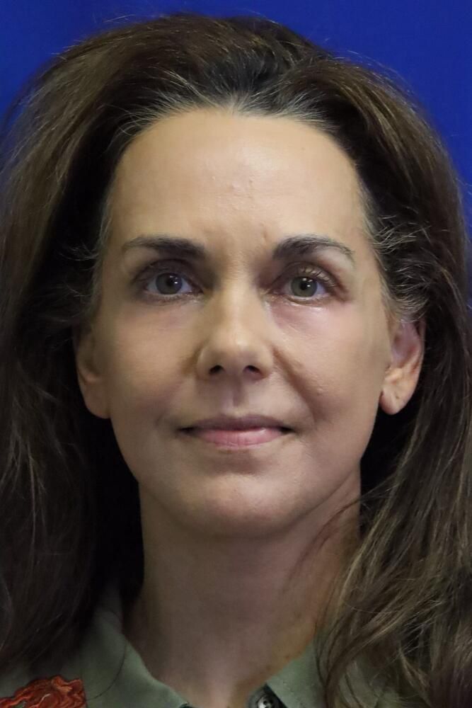 Facial Fat Transfer Before & After