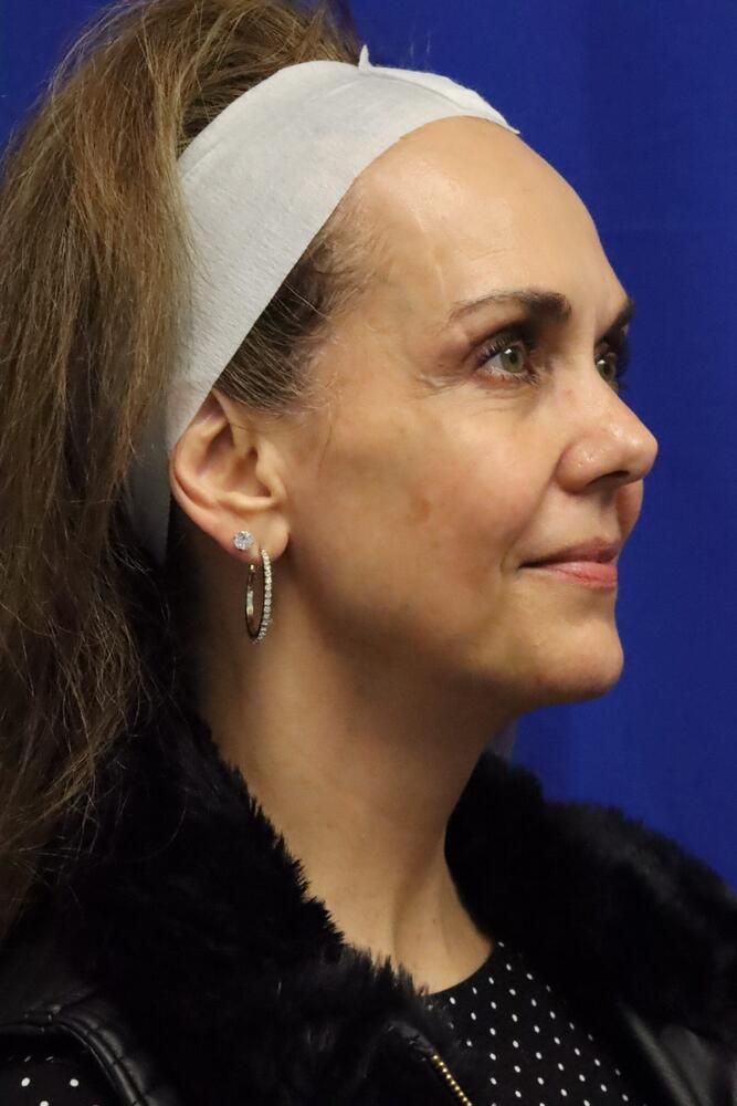 Facial Fat Transfer Before & After