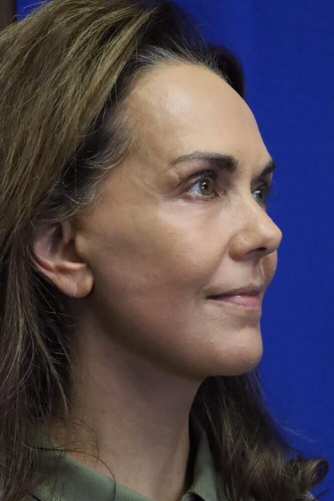 Facial Fat Transfer Before & After