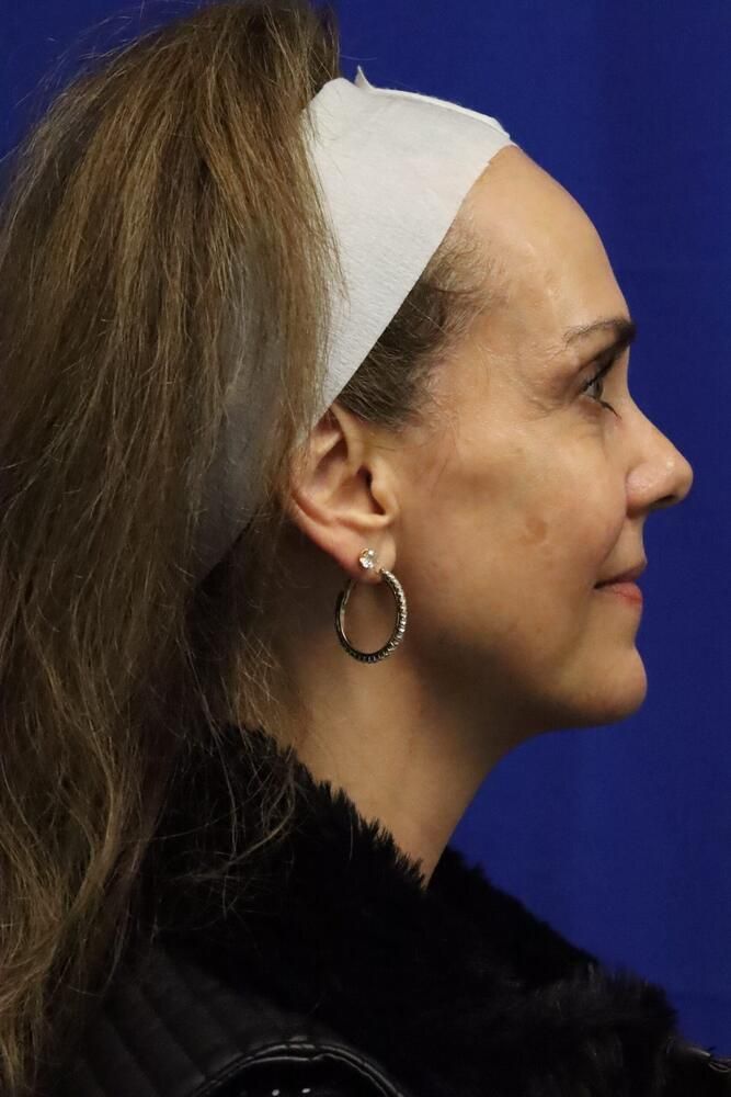 Facial Fat Transfer Before & After