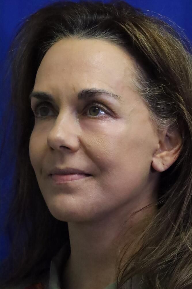 Facial Fat Transfer Before & After