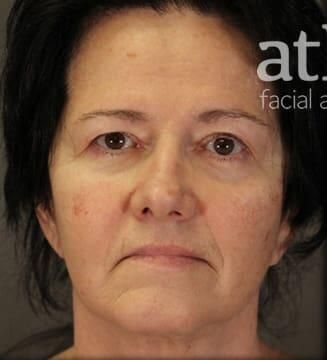 Facial Fat Transfer Before & After