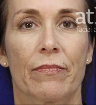 Facial Fat Transfer Before & After