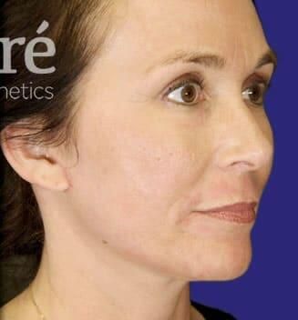 Facial Fat Transfer Before & After