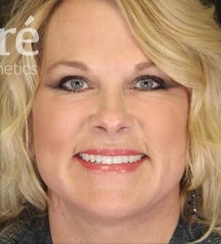 Facial Fat Transfer Before & After