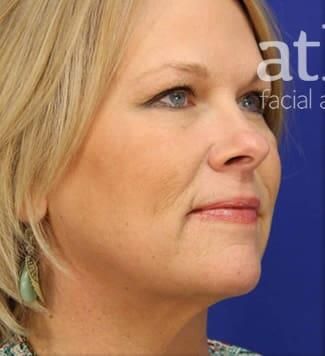 Facial Fat Transfer Before & After