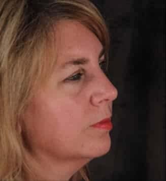 Facial Fat Transfer Before & After