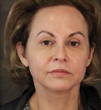 Facial Fat Transfer Before & After