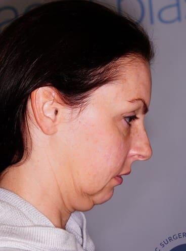 Facial Fat Transfer Before & After