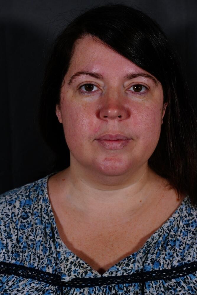 Facial Fat Transfer Before & After