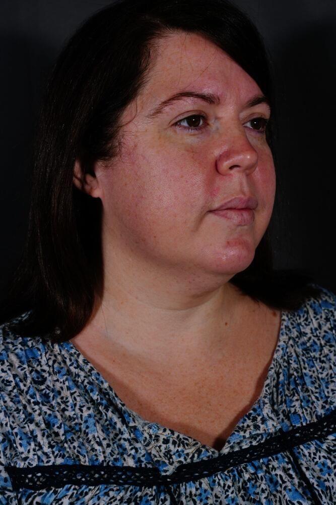 Facial Fat Transfer Before & After