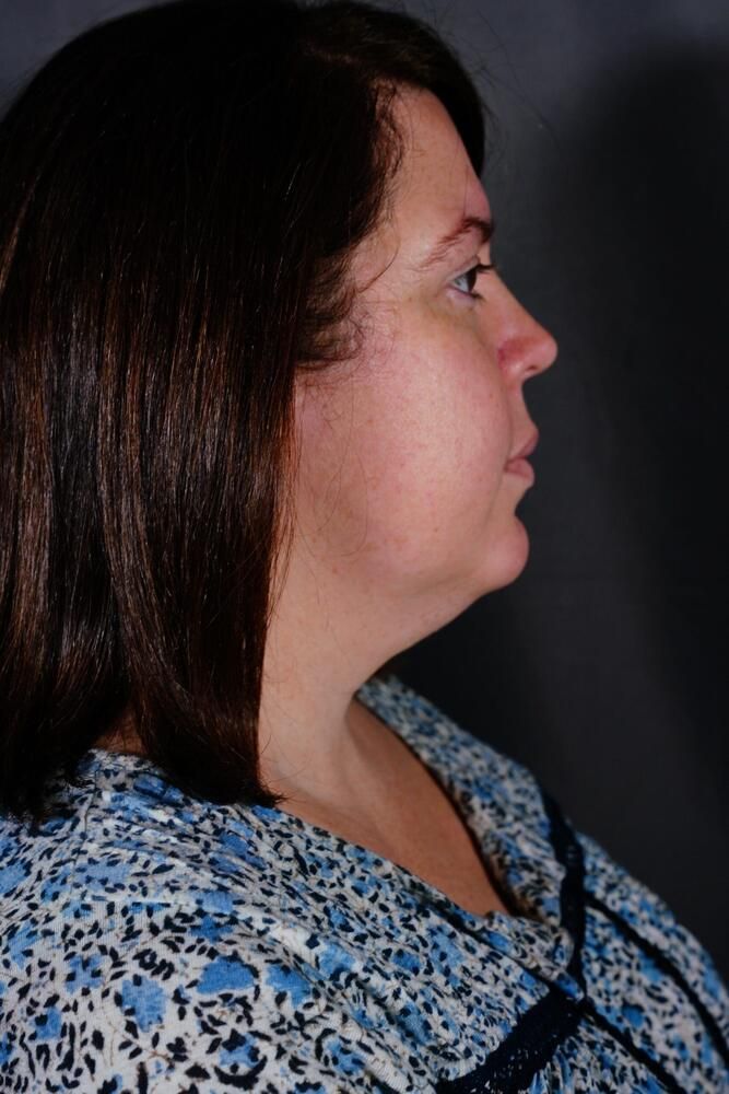 Facial Fat Transfer Before & After