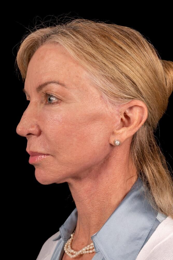 Facial Fat Transfer Before & After