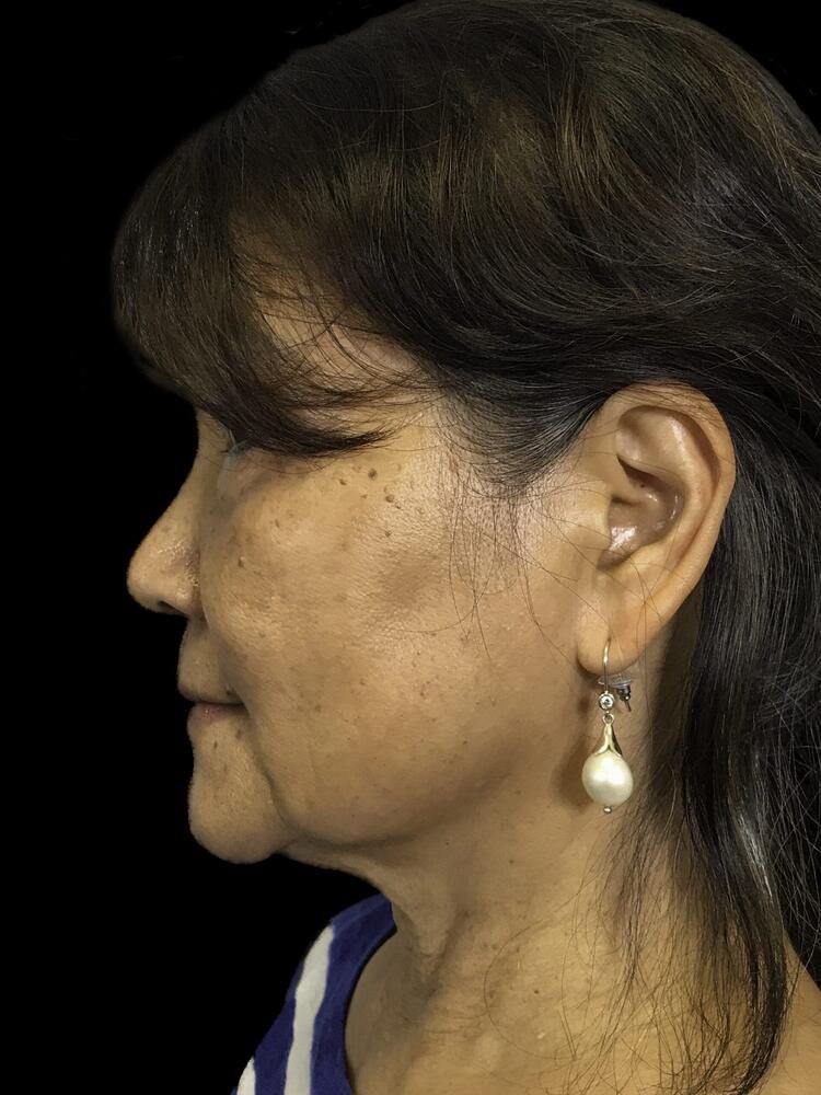 Facial Fat Transfer Before & After