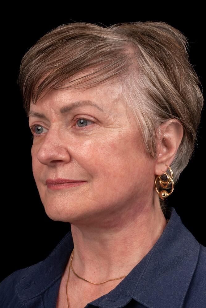 Facial Fat Transfer Before & After