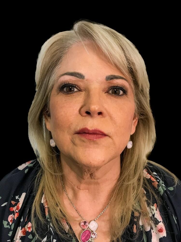 Facial Fat Transfer Before & After