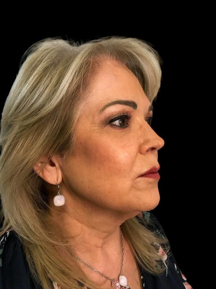 Facial Fat Transfer Before & After