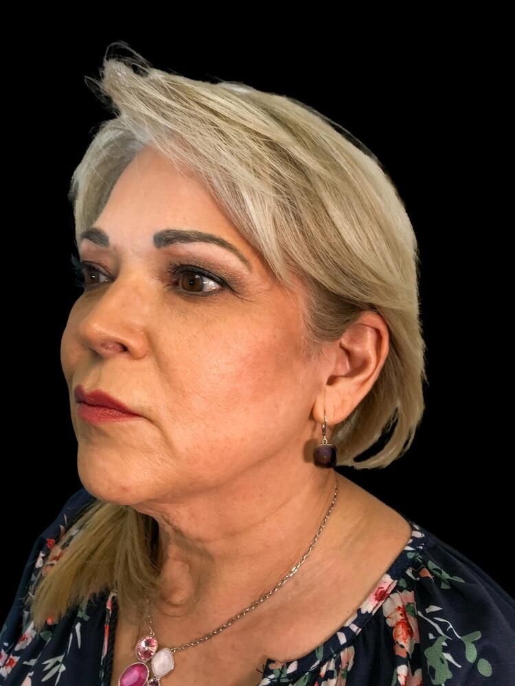 Facial Fat Transfer Before & After