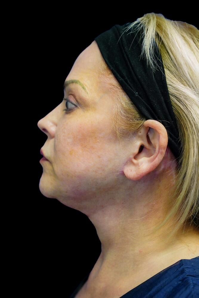 Facial Fat Transfer Before & After