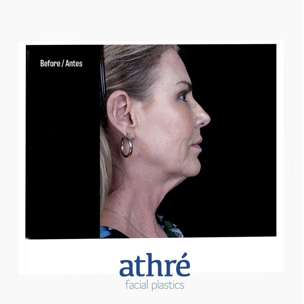 Facial Fat Transfer Before & After