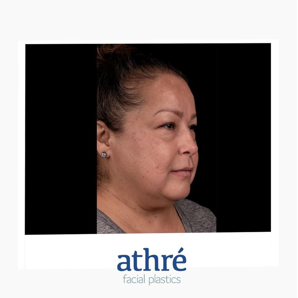 Facial Fat Transfer Before & After