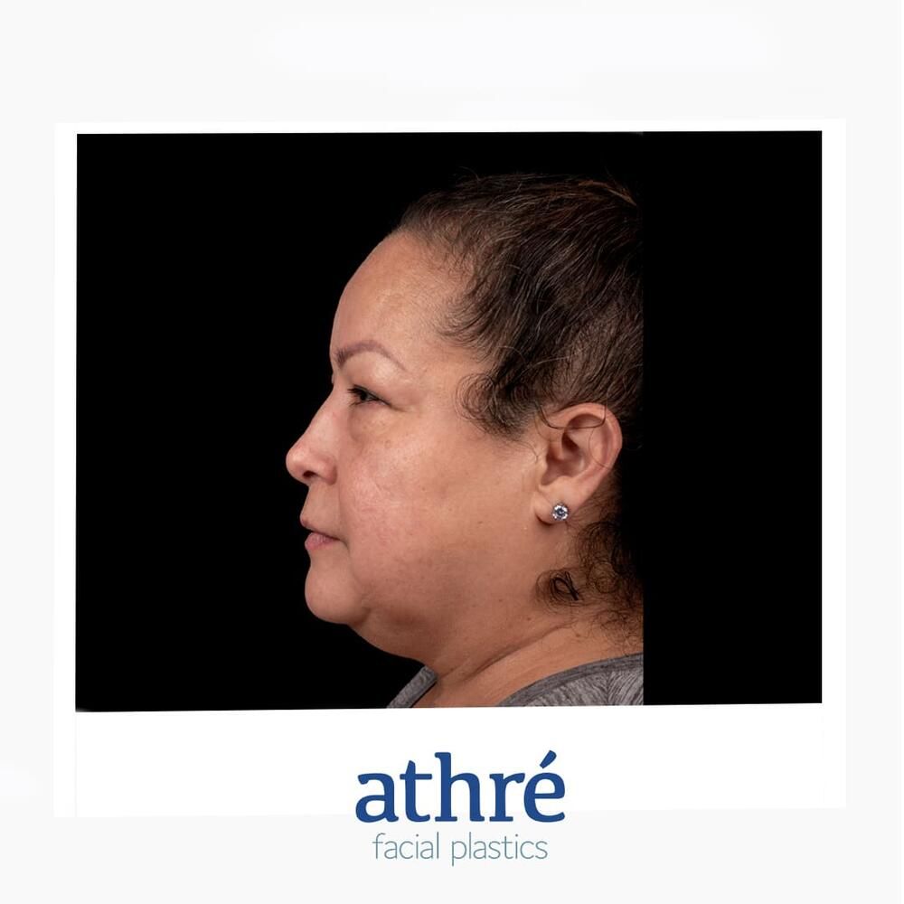 Facial Fat Transfer Before & After